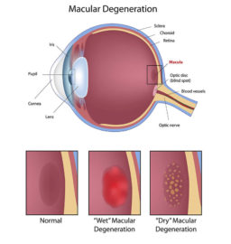 eastside macular degeneration